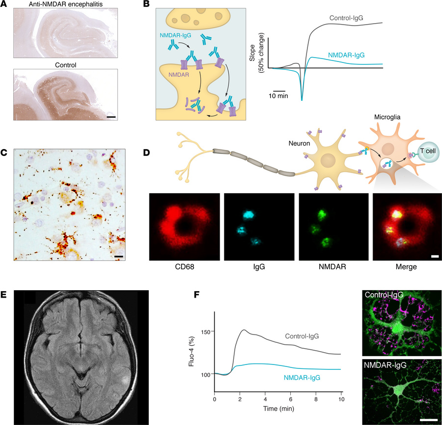 Effects of NMDAR autoantibodies on neurons and synaptic networks, microg...