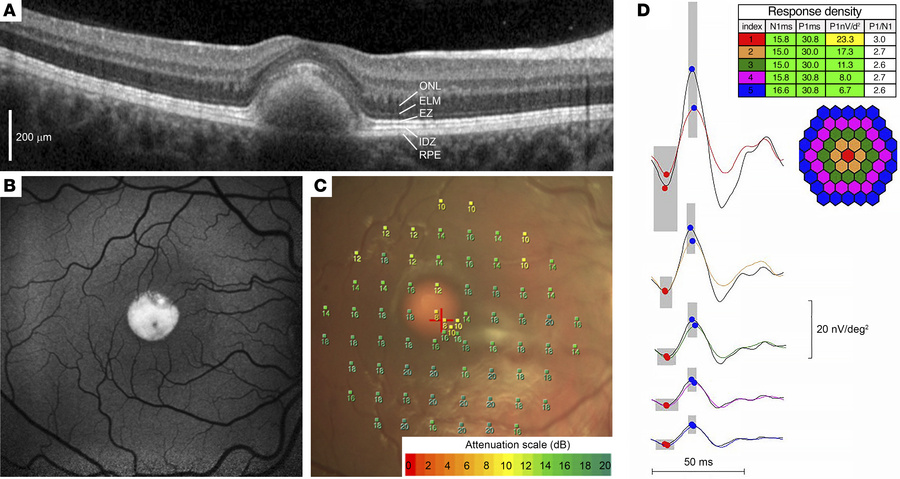 Vitelliform macular dystrophy is characterized by a separation of photor...