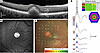 Vitelliform macular dystrophy is characterized by a separation of photorece