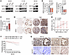NAT10 positively regulates DKK2 expression with high expression of both ass