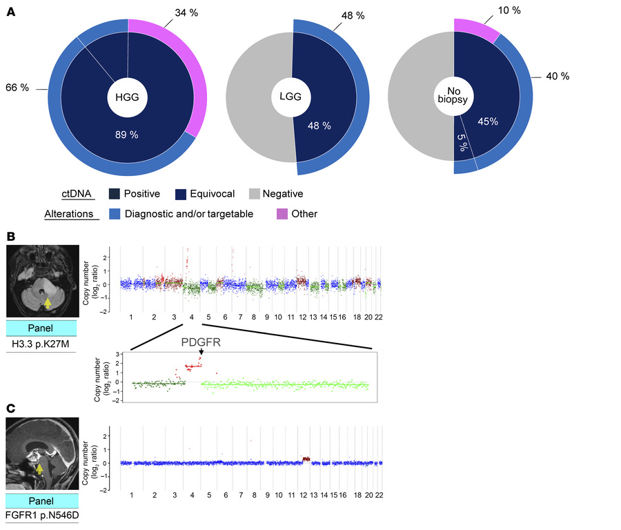 Liquid biopsy at diagnosis of pediatric gliomas.
(A) The pie charts show...