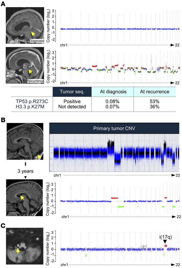 Liquid biopsy at recurrence and progression.
(A) Diffuse midline glioma....