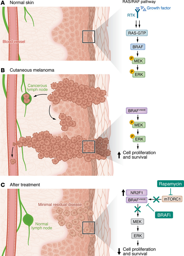 JCI - NR2F1 and mTORC1 provide the bridge between melanoma dormancy and ...