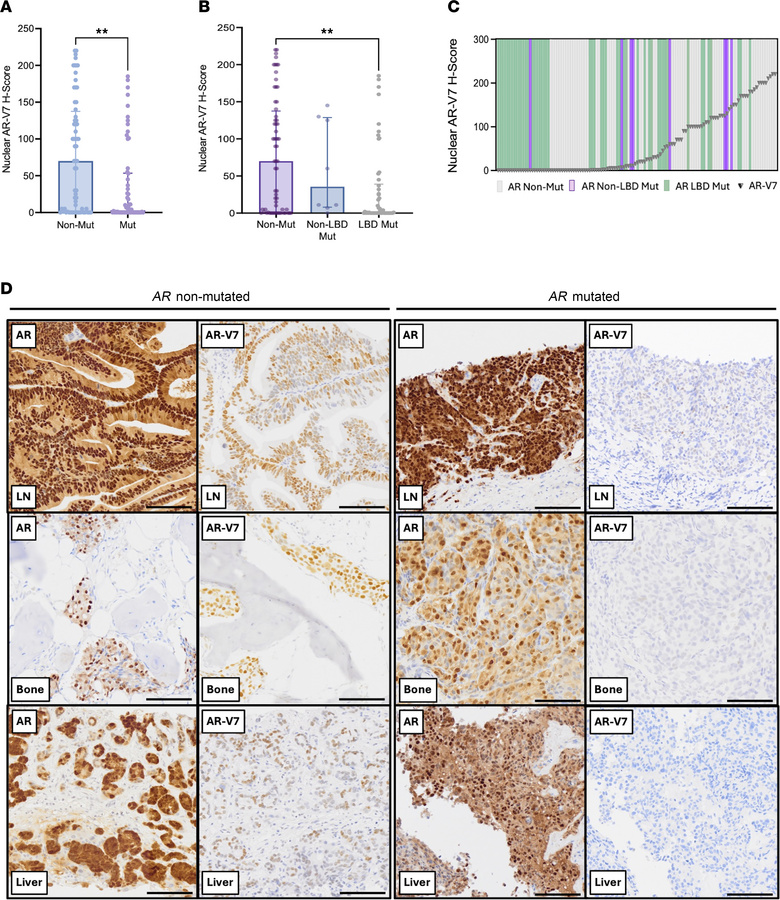mCRPC patient tissue samples with detectable AR mutations exhibit lower ...