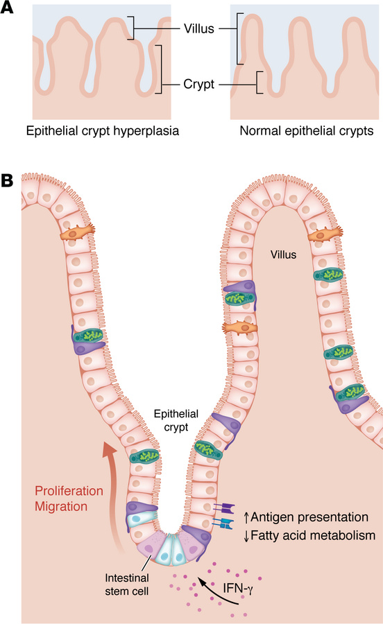 Epithelial crypt hyperplasia is driven by IFN-γ.
(A) In celiac disease, ...