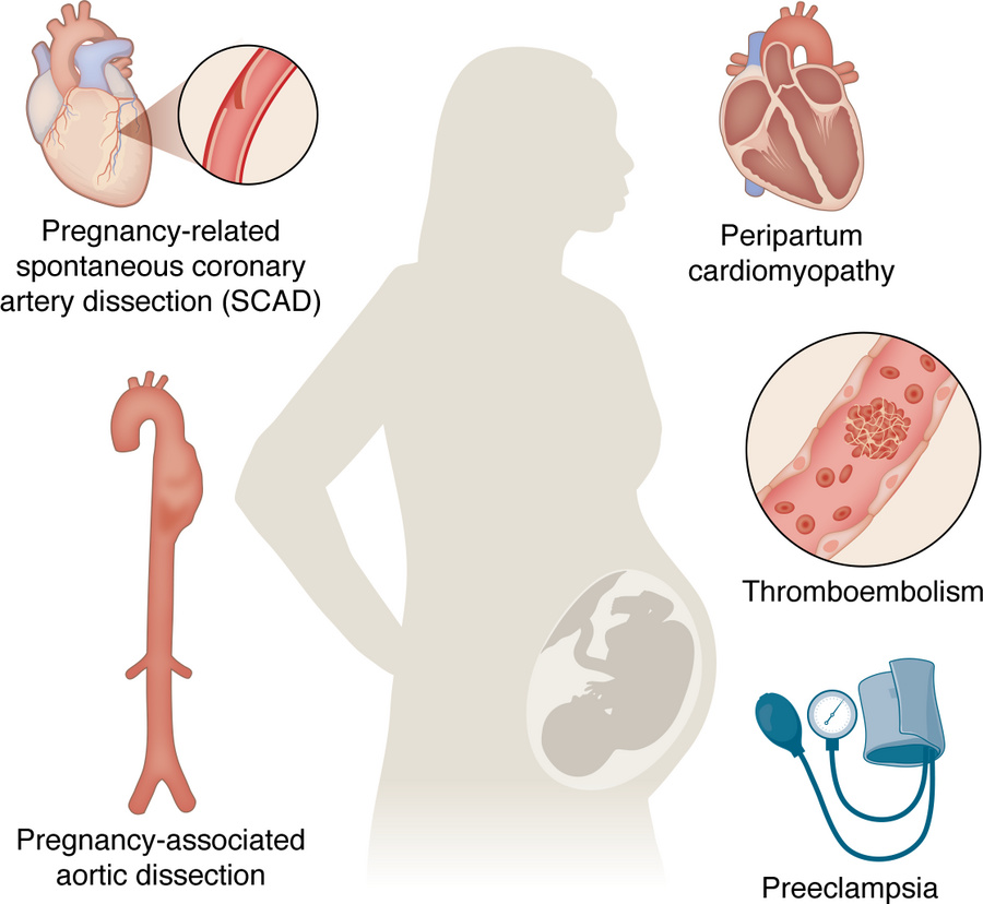 Cardiovascular complications of pregnancy.
Cardiovascular diseases are t...