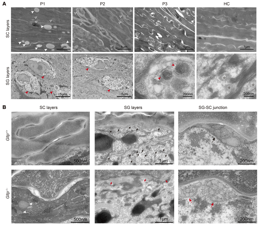 Ultrastructural changes in the epidermis of GLTP-nEDD patients and the G...