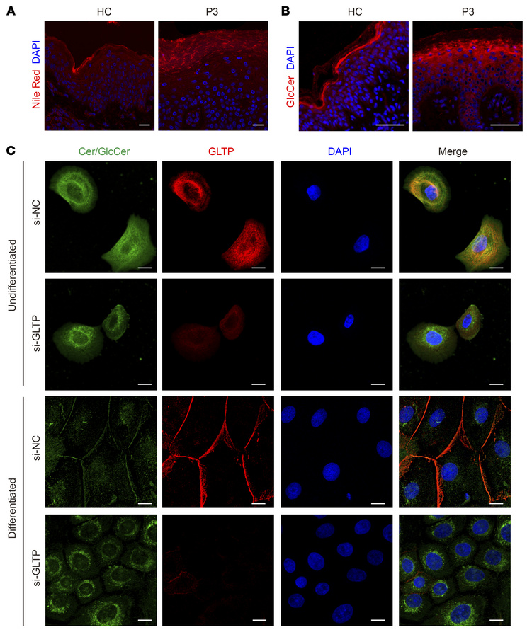 Aberrant glucosylceramide transport in GLTP-deficient differentiated ker...