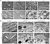 Ultrastructural changes in the epidermis of GLTP-nEDD patients and the Gltp
