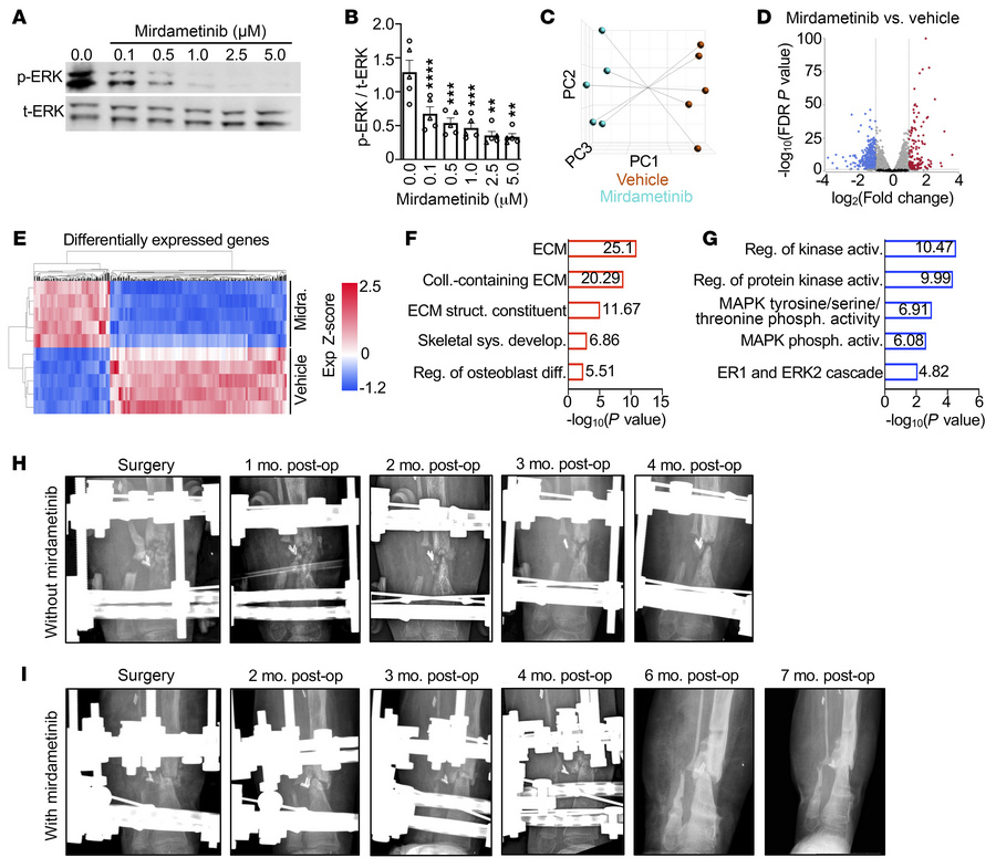Mirdametinib improves pseudarthrosis healing in a patient with OFD.
(A a...