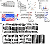 Mirdametinib improves pseudarthrosis healing in a patient with OFD.
