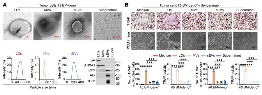 Denosumab-resistant ER+ breast cancer secretes LOs to promote RANKL-inde...