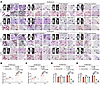 Therapeutic targeting of CARM1 inhibits denosumab-resistant bone metastasis