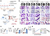 Denosumab-resistant ER+ breast cancer secretes LOs to promote RANKL-indepen