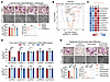 circCCDC50 mediates denosumab-resistant bone metastasis in ER+ breast cance