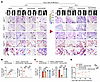 circCCDC50 mediates ER+ breast cancer denosumab resistant bone metastasis i