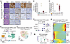 EED inactivation promotes LUAD histology likely through a NEUROD1-positive