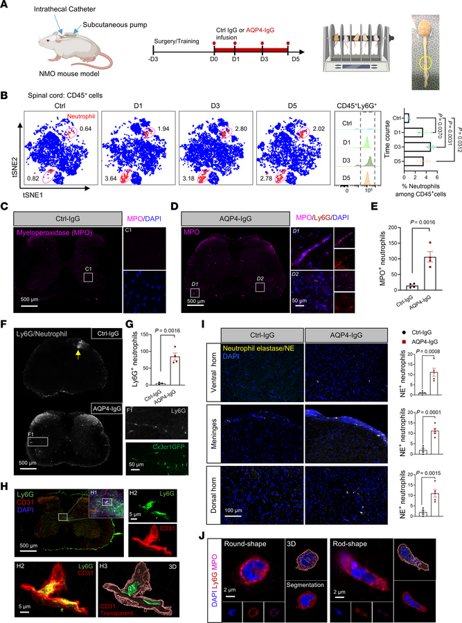 Neutrophils infiltrating and extruding extracellular traps (NETosis) in ...