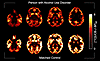 Synaptic density images by diagnostic group.