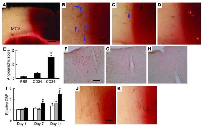 Transplantation of CD34+ cells after stroke accelerates neovascularizati...