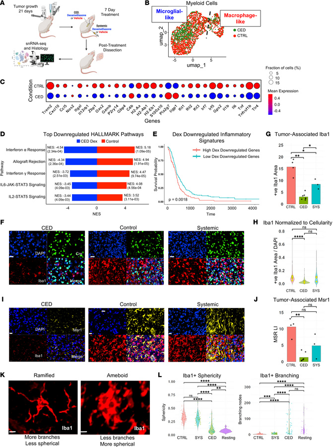 CED-dexamethasone suppresses inflammatory myeloid programs in glioma, re...
