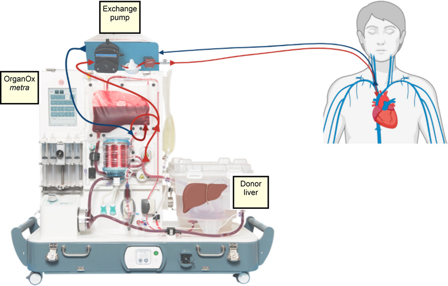 Schematic of extracorporeal cross-circuit.
Extracorporeal cross-circulat...