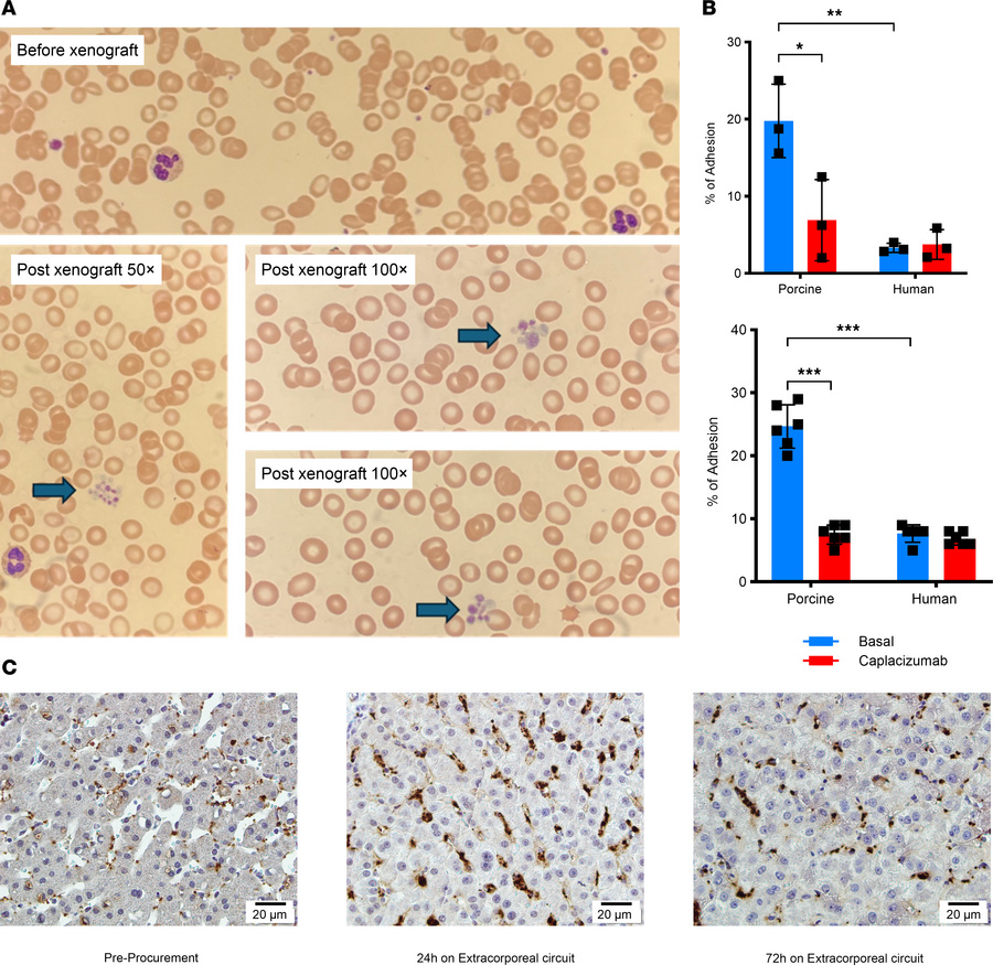 Thrombocytopenia and platelet clumping exhibited in decedent receiving e...