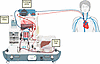 Schematic of extracorporeal cross-circuit.