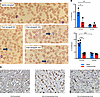 Thrombocytopenia and platelet clumping exhibited in decedent receiving extr