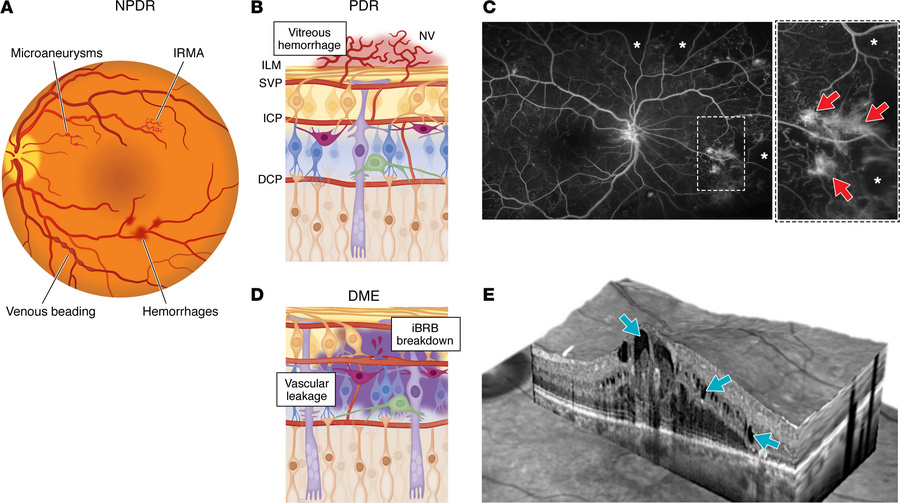 Retinal structure changes in diabetic retinopathy.
(A) Schematic diagram...