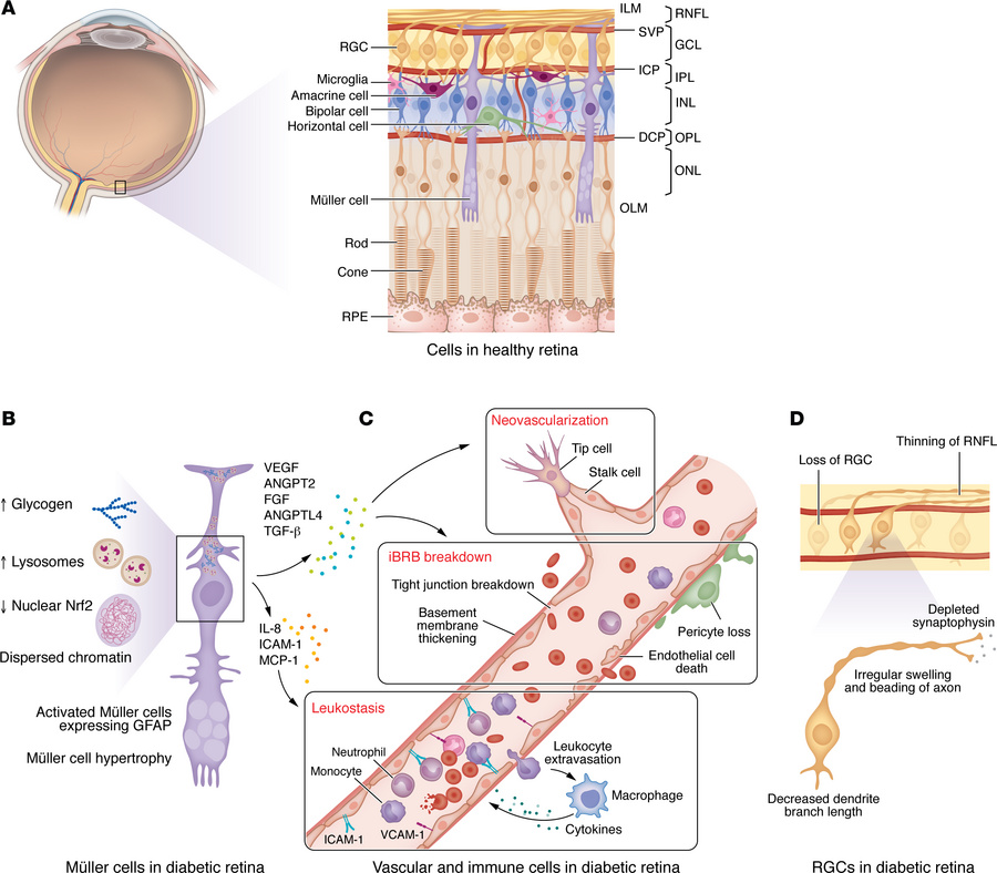 Retinal cellular structural changes in diabetic retinopathy.
(A) Schemat...