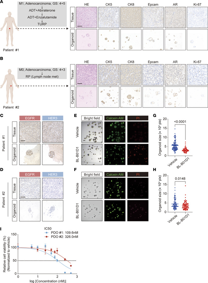 Antitumor activity of BL-B01D1 in PDO models.
(A and B) Clinical history...