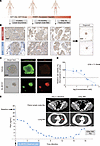 Clinical efficacy of BL-B01D1 in a patient with mCRPC and matched PDO valid