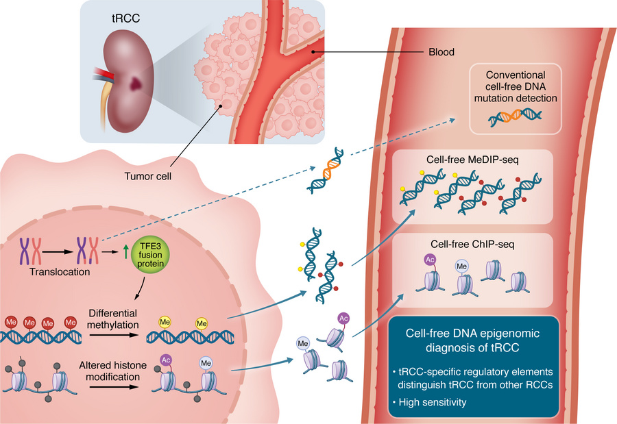 Cell-free DNA–based epigenomic diagnosis of tRCC.
In tRCC, chromosomal t...