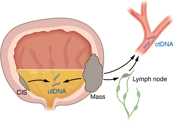 Liquid biopsies.
Advances in the ability to detect and analyze urinary t...