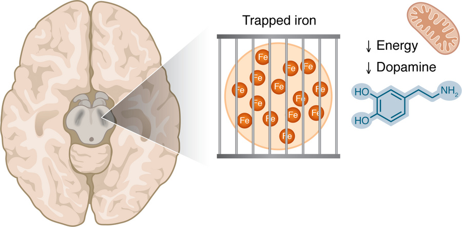 Iron accumulation in the substantia nigra is visible by MRI techniques i...