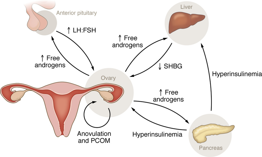 PCOS/PMOS pathophysiology.
PCOS/PMOS is a complicated syndrome, involvin...