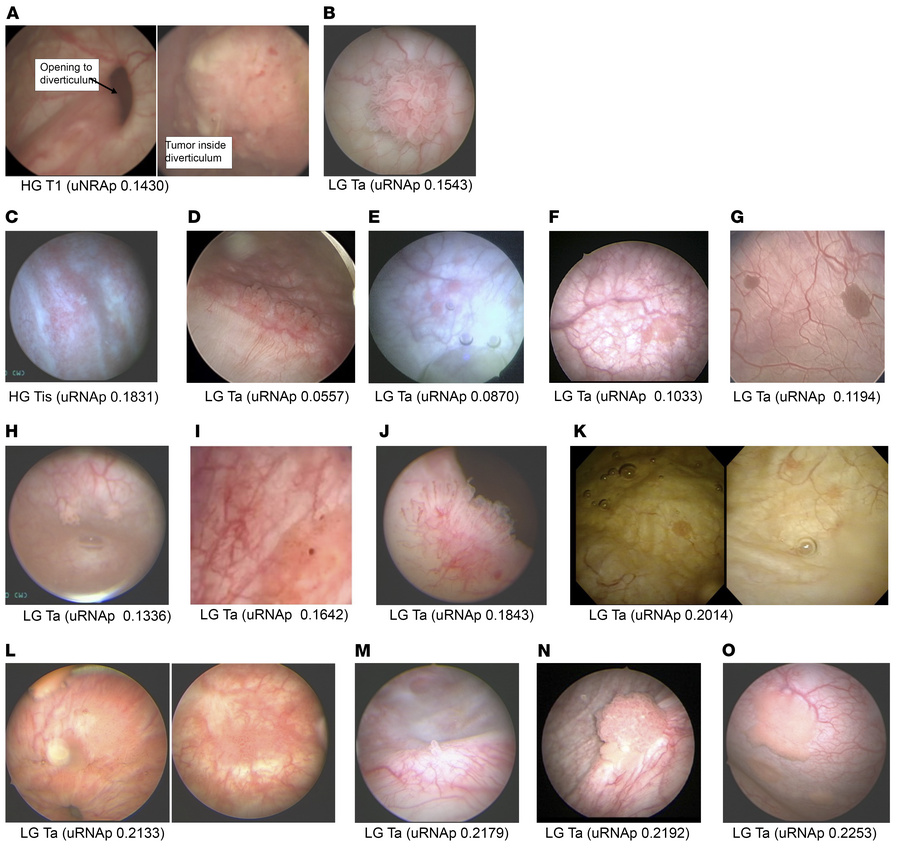 Cystoscopic appearance of bladder cancer cases with false negative uRNAp...