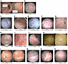 Cystoscopic appearance of bladder cancer cases with false negative uRNAp te