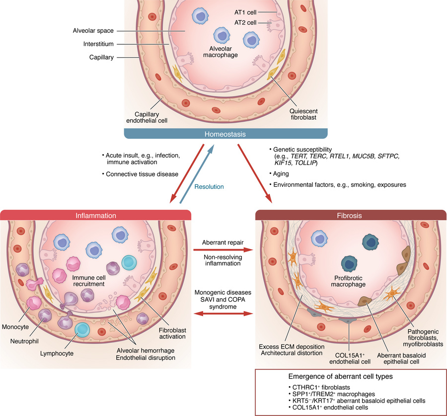 A conceptual framework for ILD pathogenesis.
Predisposition to ILDs is i...