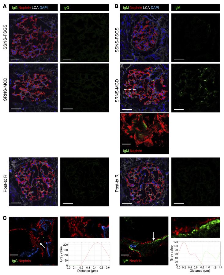 IgG, IgM, and nephrin immunolabeling in kidney biopsies.
(A) Representat...