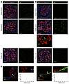 IgG, IgM, and nephrin immunolabeling in kidney biopsies.