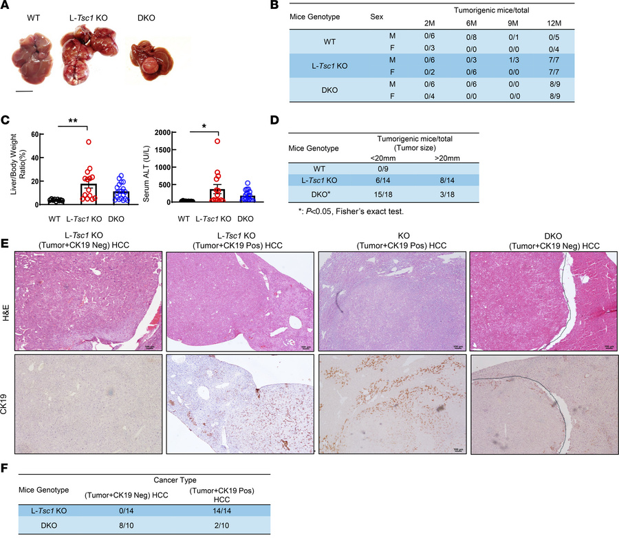Increased tumor burden and SOX9-positive HCC with increased CK19-positiv...