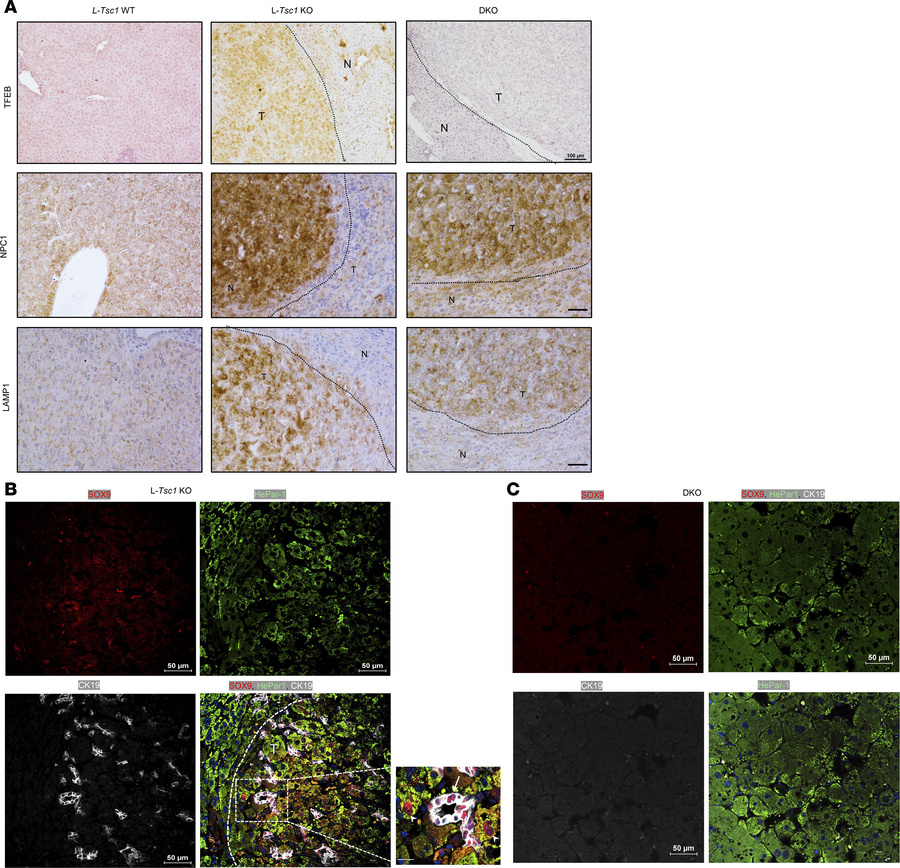 Increased SOX9-positive HCC with increased CK19-positive ductular cell i...