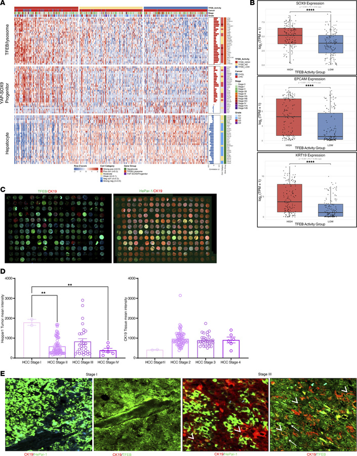 TFEB transcriptional activity is associated with progenitor-like program...