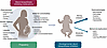 Proposed neurodevelopmental pathophysiology and consequences of development