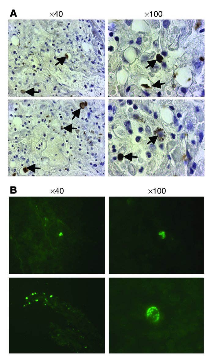 Detection of LukS-PV and of DNA-fragmented cells in lung sections of pat...