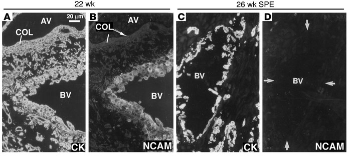 In severe preeclampsia as compared to normal pregnancy, cytotrophoblast ...