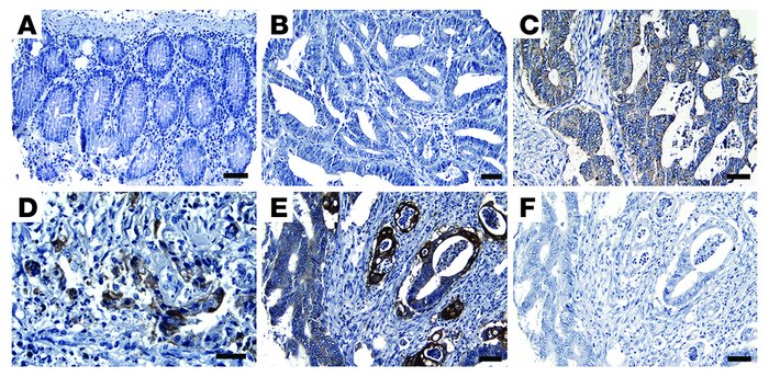 Expression of αvβ6 in malignant human colon carcinoma. (A–E) Representat...