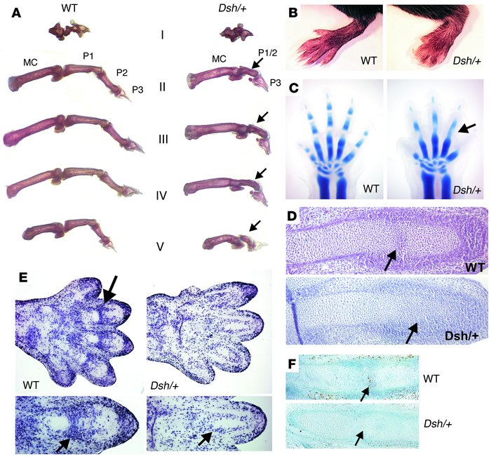 The Dsh/+ limb phenotype. (A) Alizarin red–stained skeletal preparations...